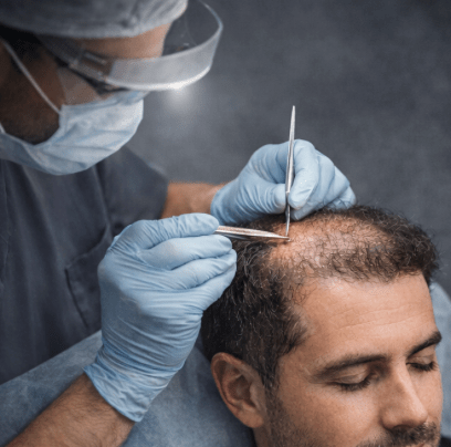 Wie funktioniert eine Haartransplantation? Ablauf, Methoden und Ergebnisse einfach erklärt