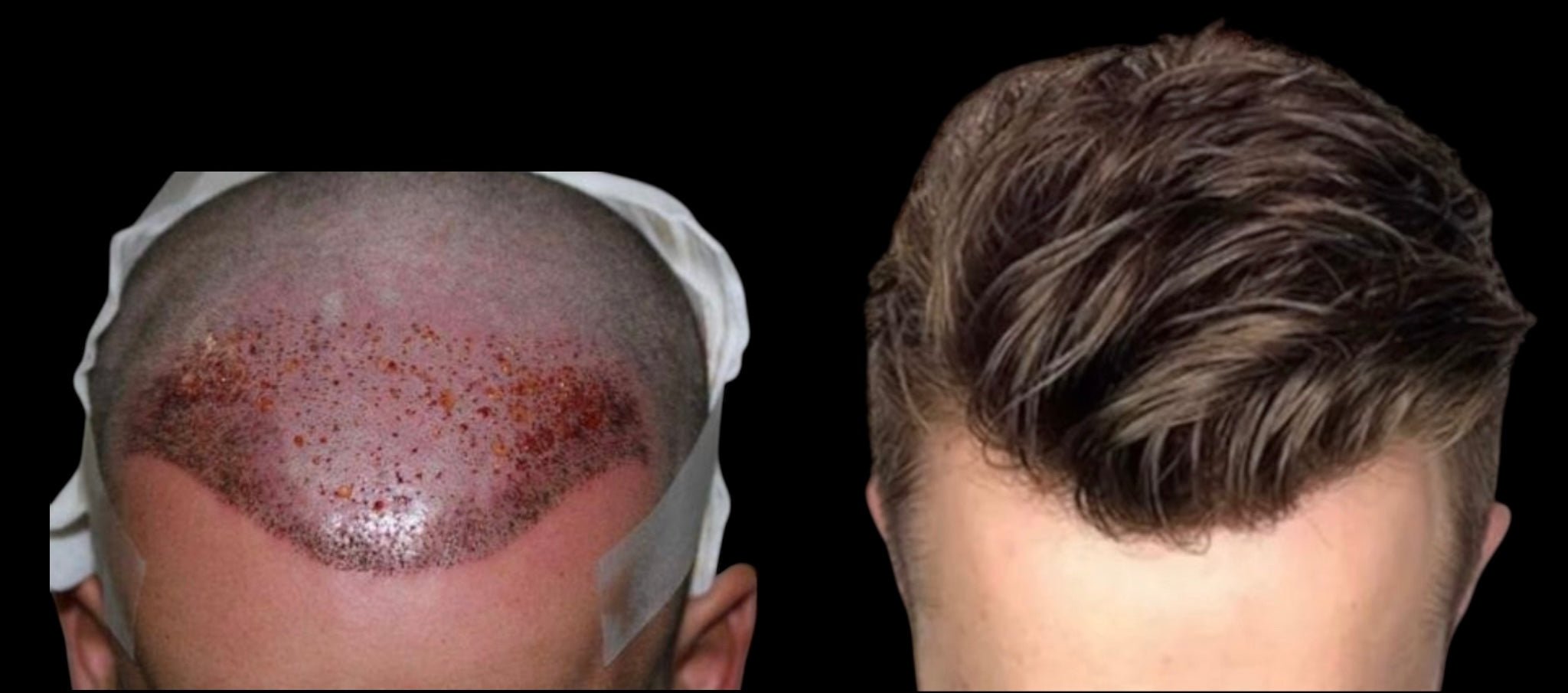 Haartransplantation vs. Haarsystem
