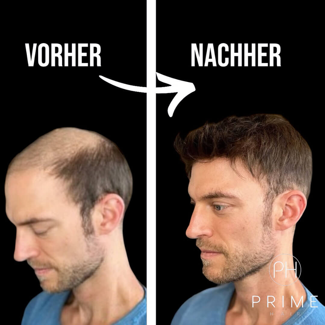 Vorher / Nachher eines Mannes mit Haarsystem