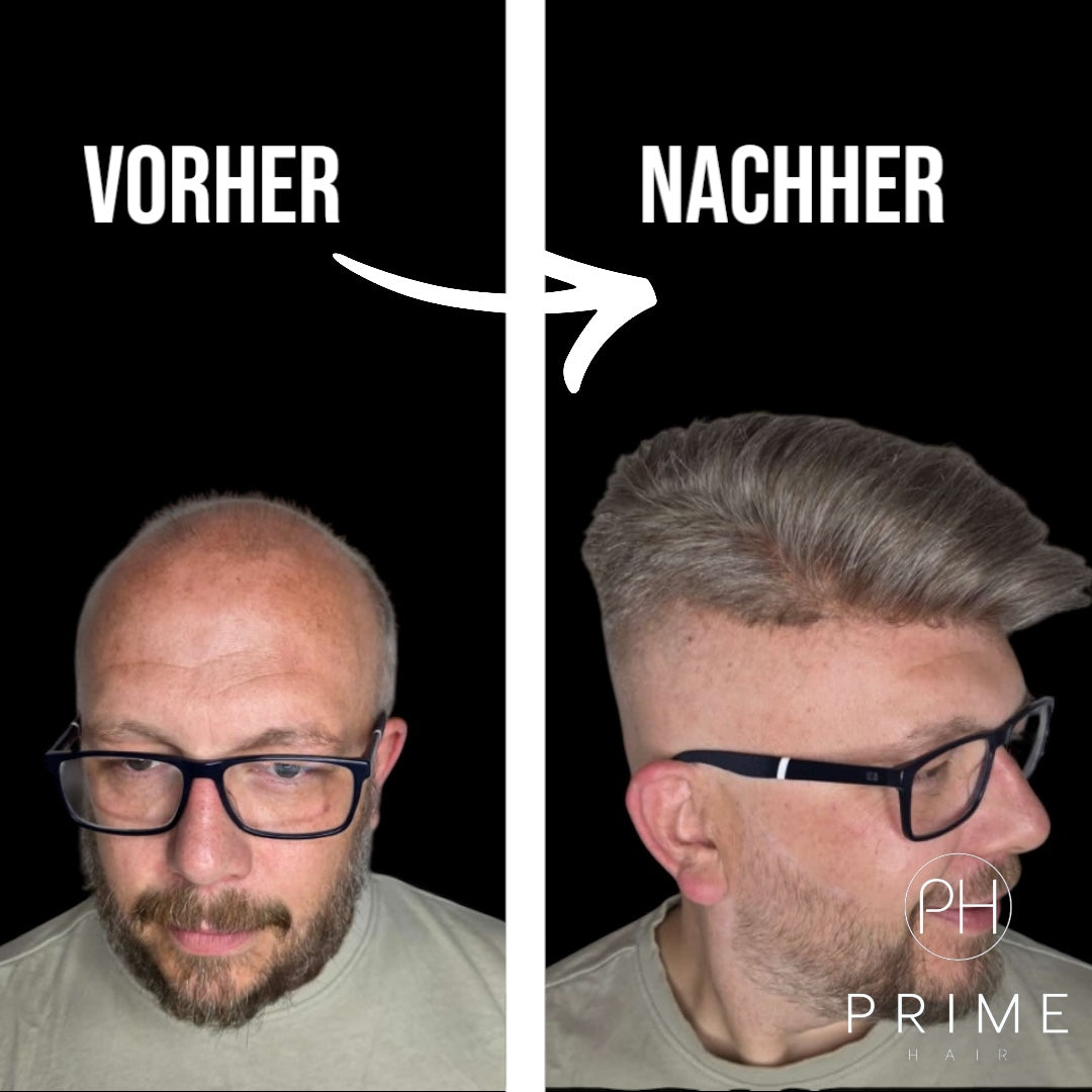 Vorher / Nachher eines Mannes mit Haarsystem
