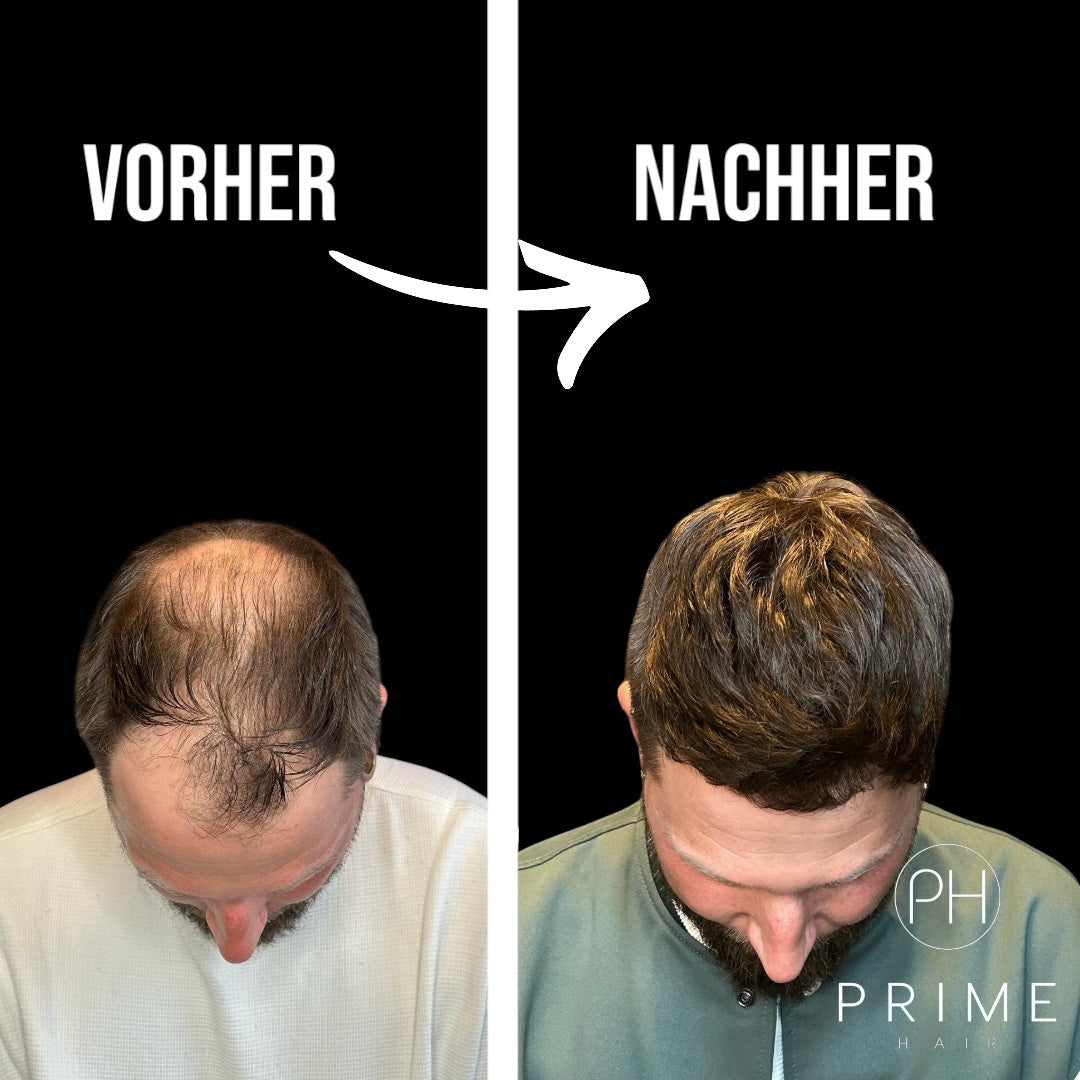 Vorher - Nachher Bild mit Haarsystem